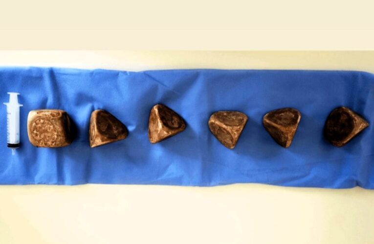 У сечовому міхурі чоловіка знайшли 2 кг каменів