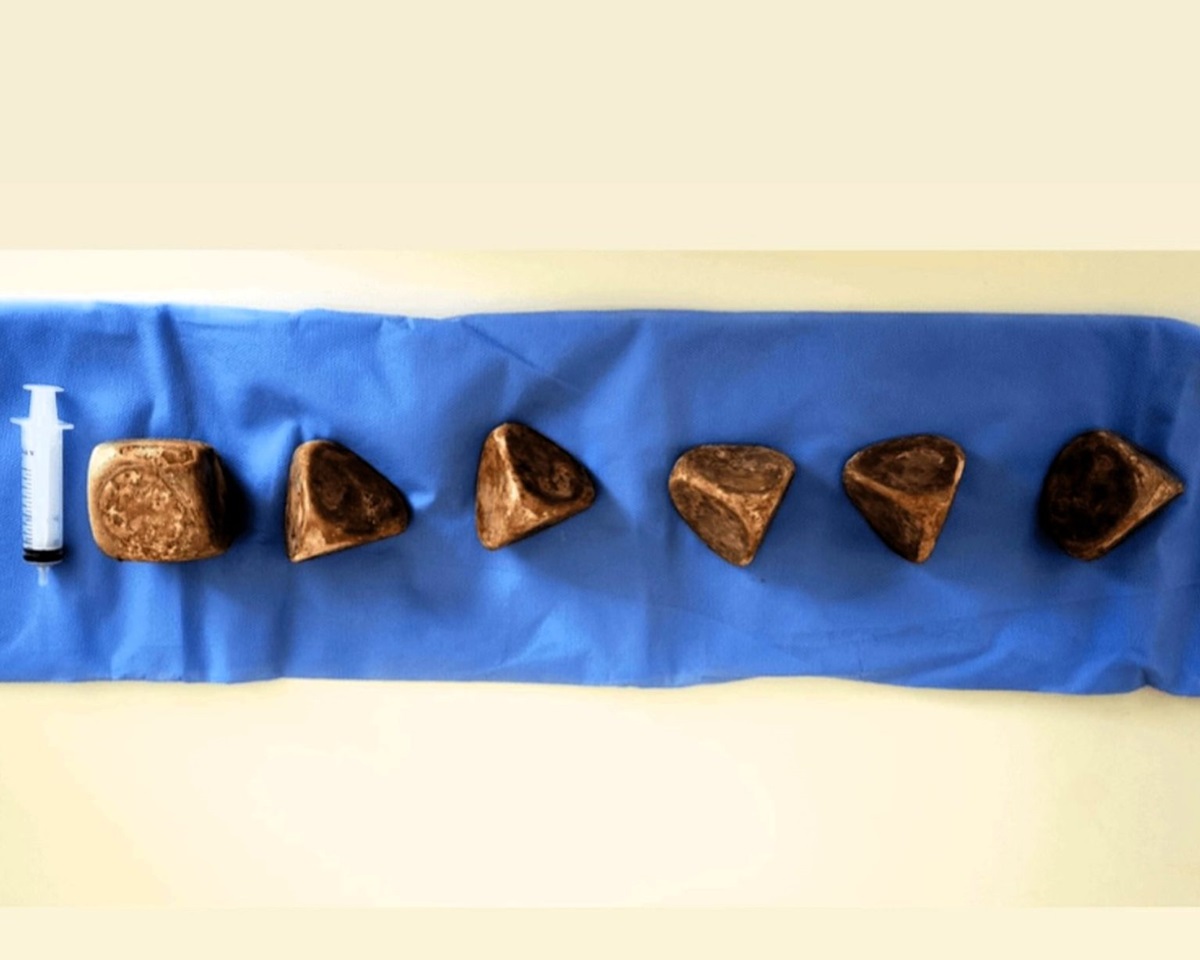 Новини світу - У сечовому міхурі чоловіка знайшли 2 кг каменів