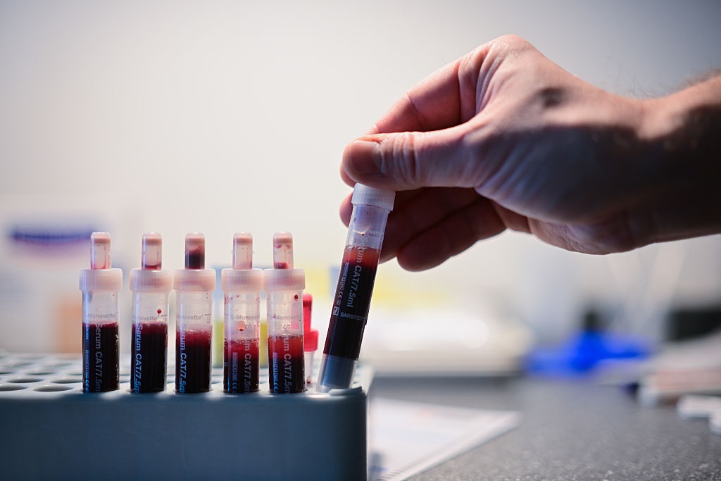 Новини України - Відомо, скільки випадків ВІЛ-інфекції зафіксували в Україні з початку року