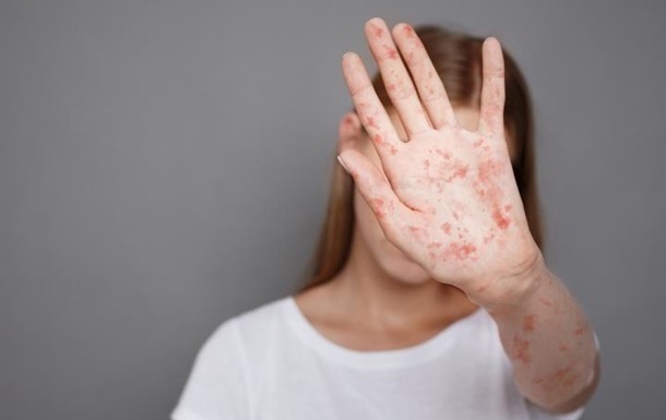 Новини України - Захворюваність на кір в Україні зросла удесятеро